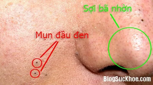 Mẹo đơn giản giúp bạn không bao giờ bị mụn đầu đen