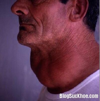 buou co Nguyên nhân và triệu chứng bệnh bướu cổ