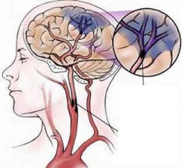 nao Dấu hiệu nhận biết và nguyên nhân gây xuất huyết não