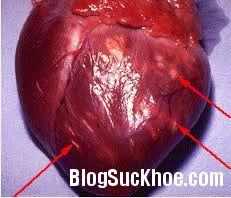 tim1 Triệu chứng và nguyên nhân gây viêm cơ tim