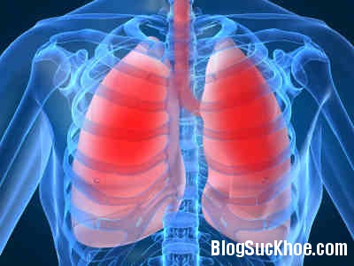 viem phoi Nguyên nhân mắc viêm phổi