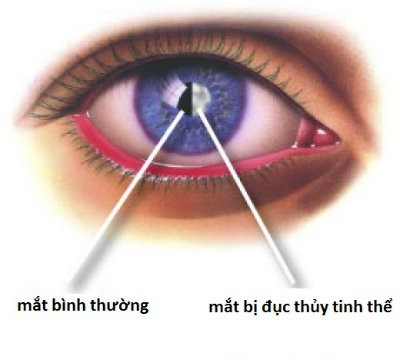 mat 4 bệnh ở mắt có thể gây ra mù lòa