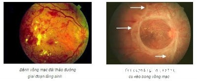 mat1 4 bệnh ở mắt có thể gây ra mù lòa