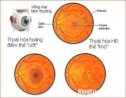 mat3 4 bệnh ở mắt có thể gây ra mù lòa