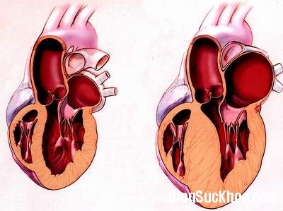 tim11 Tìm hiểu bệnh cơ tim phì đại