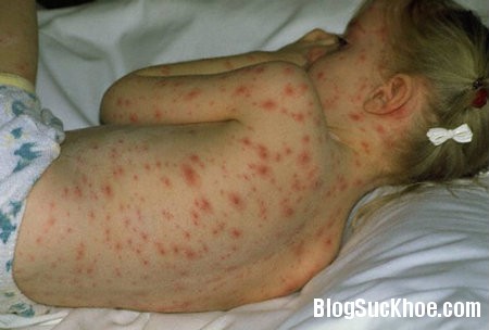 phat ban Nguyên nhân và dấu hiệu nhận biết trẻ bị sốt phát ban
