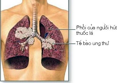 ungthuphoi Những dấu hiệu cảnh báo ung thư phổi sớm