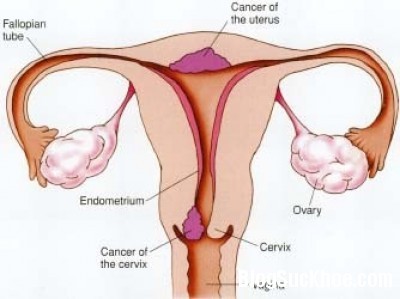2 Những bệnh thường gặp ở tử cung