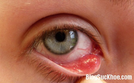 mat1 Một số điều cần biết về bệnh đau mắt đỏ