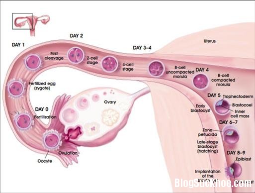 tac ong dan trung o phu nu Bệnh tắc ống dẫn trứng, vòi trứng gây vô sinh, không thể có con