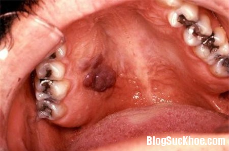 ung thu2 Quan hệ bằng miệng – đường tắt dẫn tới ung thư họng