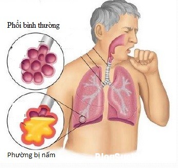phoi2 Đường lây và biểu hiện của bệnh nấm phổi