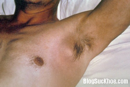 hach Những dấu hiệu nhiễm HIV ban đầu ở nam giới