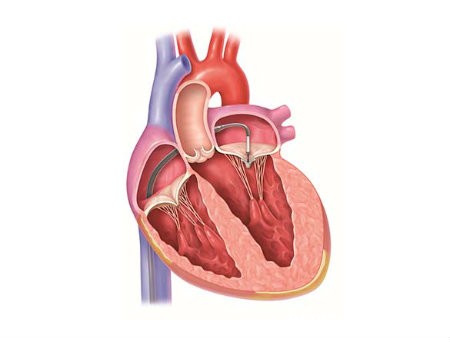 tim Những điểm mới trong điều trị bệnh van tim