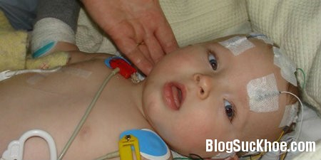 xuat huyet Nguyên nhân và cách phòng tránh xuất huyết não ở trẻ em