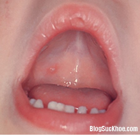 1197 Những bệnh ở miệng thường gặp ở trẻ