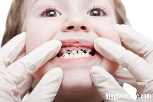 1246 Các bệnh phổ biến về răng miệng thường gặp ở trẻ nhỏ