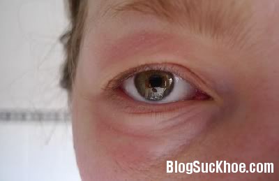 1322 Nguyên nhân và cách điều trị viêm mí mắt