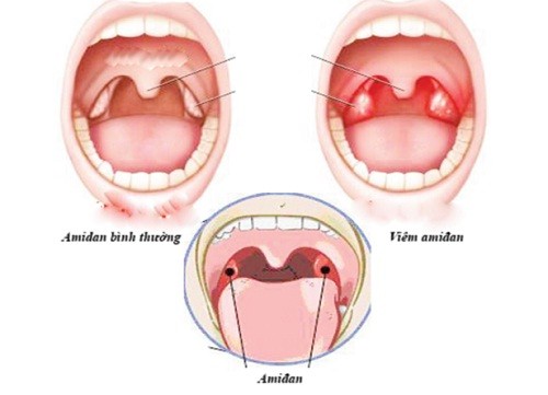 1337 Các biểu hiện viêm amydal