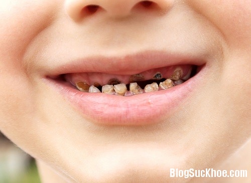 1161 Bệnh sâu răng ở trẻ nhỏ