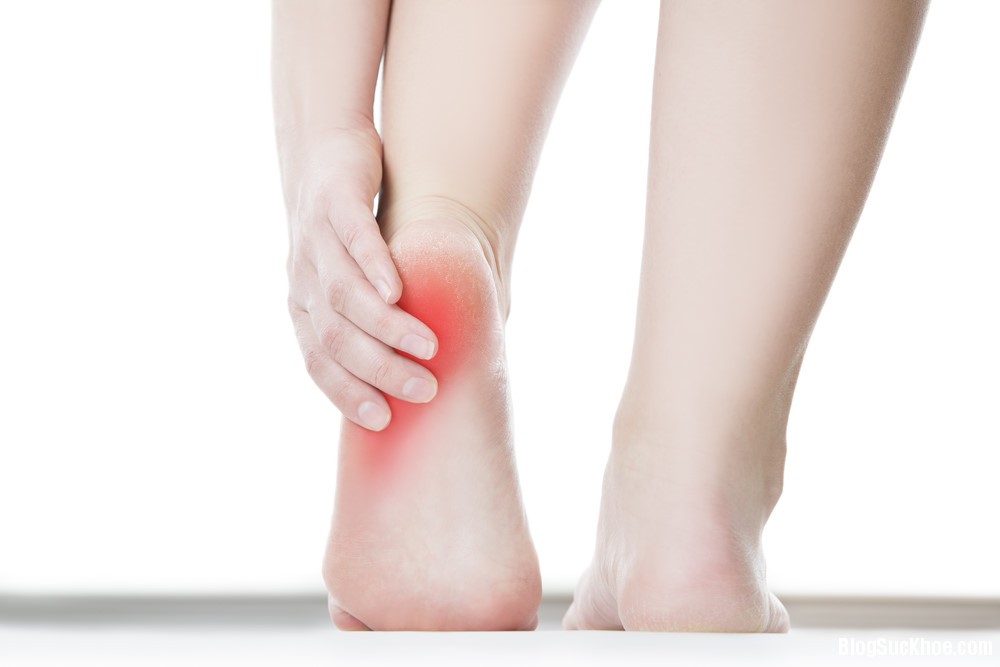 1 65 Những bài thuốc Đông y giúp chữa đau gót chân