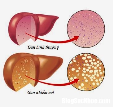 1498269434 21 v Gan nhiễm mỡ không chỉ có người người lớn mới bị