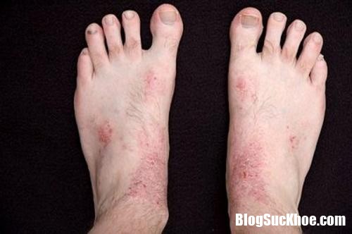 3 loai nam thuong tan cong ban chan2 Những họ nhà nấm nào thường rình rập tấn công bàn chân