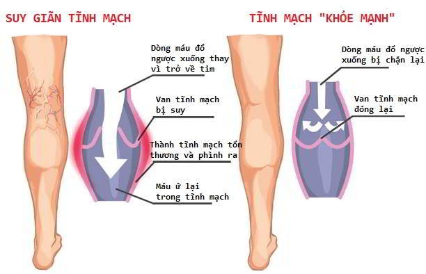 Can trong voi chung suy gian tinh mach o dan van phong gay phu chan dot tu 1 Suy giãn tĩnh mạch ở dân văn phòng