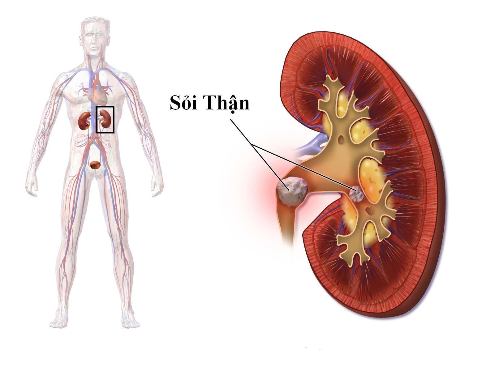 iu tr si thn sai lm gay suy thn Nguy cơ suy thận do trị sỏi thận sai cách