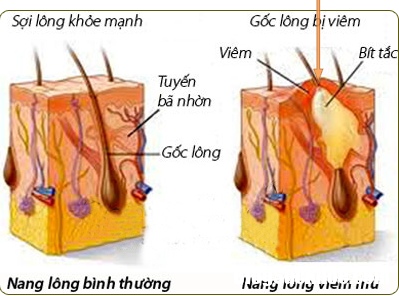 thuoc tri benh ngoai da mua mua lu Bệnh ngoài da mùa mưa lũ và cách dùng thuốc đặc trị