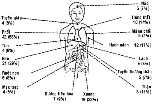 ung thu amidan 1704 1499077764 Những yếu tố nguy cơ gây ung thư amidan cần tránh