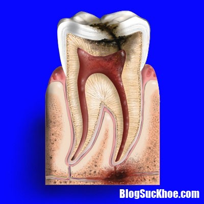 48e341 Hậu quả của viêm tủy răng