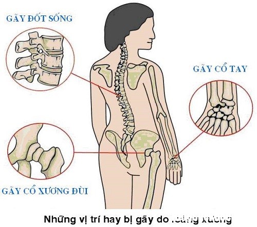 Dau hieu ban bi loang xuong ma khong biet 2 Dấu hiệu nhận biết loãng xương cần quan tâm