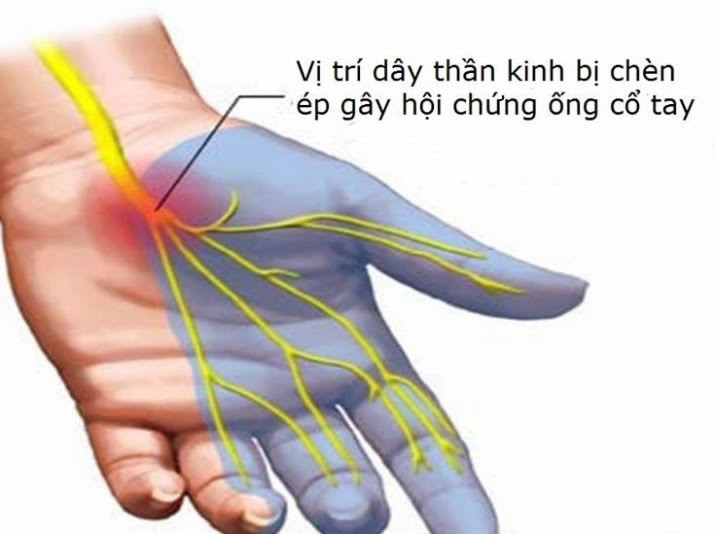 He qua nguy hiem cua hoi chung ong co tay doi voi dan van phong 2 Hội chứng ống cổ tay xuất hiện phổ biến với dân văn phòng