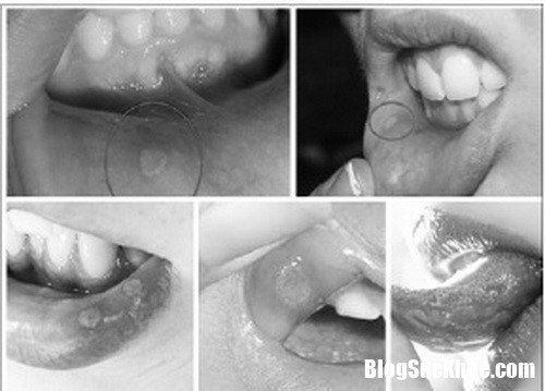 Untitle1d resize Nguyên nhân gây bệnh và cách điều trị viêm loét miệng