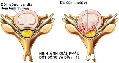 cach don gian phong thoat vi dia dem 0743072 Bệnh thoát vị đĩa đệm khi nào là nguy hiểm nhất ?