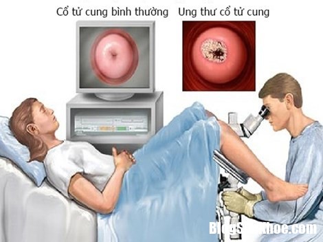 dau hieu canh bao ung thu co tu cung phu nu nen biet Những dấu hiệu đầu tiên của bệnh ung thư cổ tử cung phụ nữ nên biết