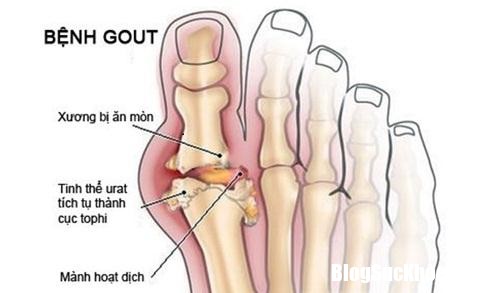 dung tho o voi nhung dau hieu benh gout 2 4214553 Những dấu hiệu bệnh gout không nên thờ ơ