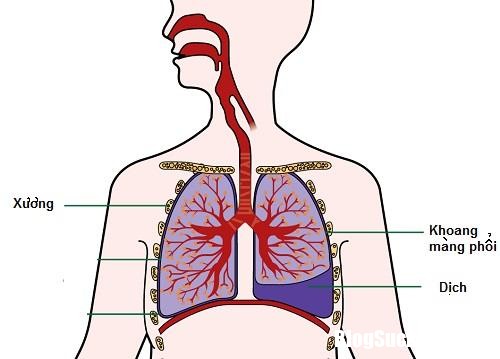 nguyen tac bat bien cua cach tri benh phoi co nuoc ban nen biet 81124396 Biến chứng và di chứng nguy hiểm của tràn dịch màng phổi