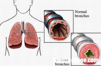 phoi1 esff.jpg Những lưu ý đối với bệnh hen khi trời rét