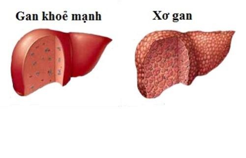 so gan 17141335 Xơ gan có thể chữa khỏi hoàn toàn được không?