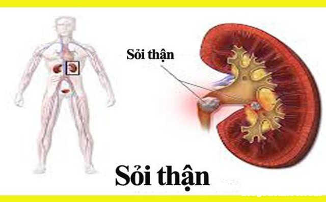 soi than Những thói quen ăn uống không hợp lý của người Việt là nguyên nhân gây bệnh sỏi thận