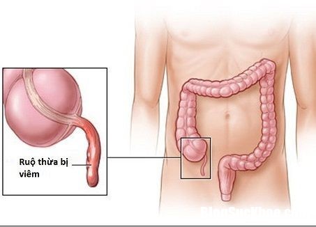 viem ruot thua Dấu hiệu nhận biết đau ruột thừa dễ nhầm lẫn với đau bụng thông thường