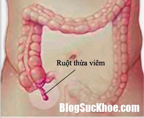 viemruotthua vmda Nhận biết bệnh viêm ruột thừa