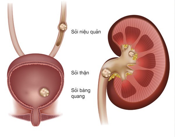 Nhung bien chung nguy hiem cua soi than 1 Sỏi thận và những biến chứng nguy hiểm không ngờ