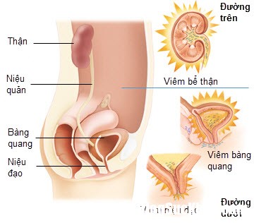 anh bai viem tiet nieu khi mang thai 1427856709614 Phòng ngừa và điều trị viêm đường tiết niệu khi mang thai