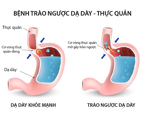 da day Chế độ ăn uống cho bệnh trào ngược dạ dày