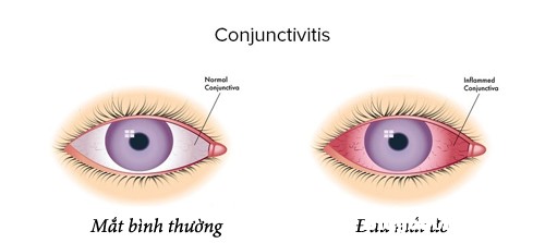 phong lay lan dau mat do 3 Cảnh báo dịch đau mắt đỏ chuẩn bị vào mùa