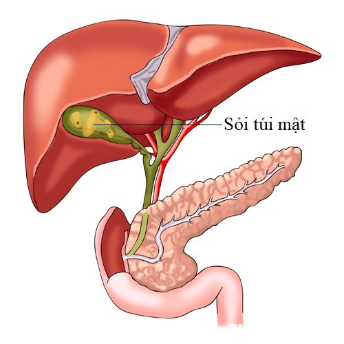 soi tui mat Kẻ sát thủ thầm lặng mang tên sỏi túi mật