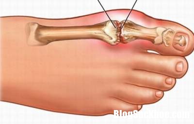 uricacidtoe Những thực phẩm phòng chống acid uric trong máu cao